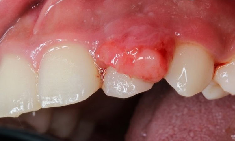 Jenis tumor gigi, Sumber: alodokter.com