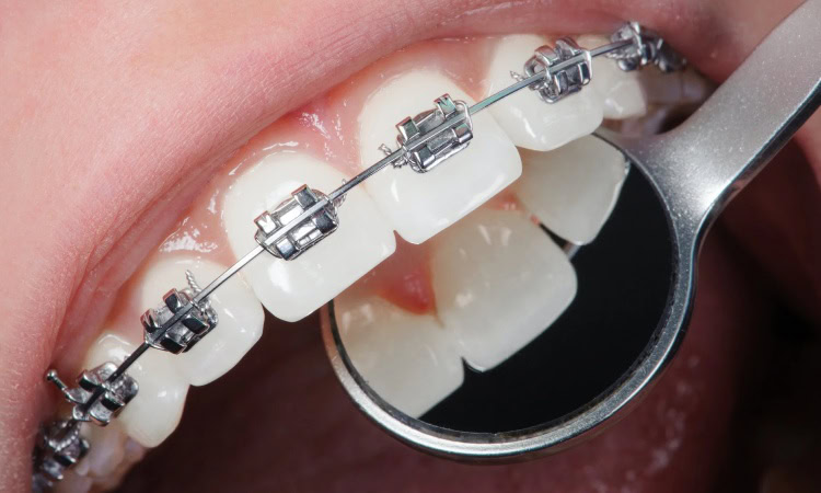 Pemasangan behel gigi, Sumber: icondentalcenter.com