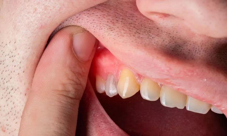Penyebab gusi gatal, Sumber: klikdokter.com