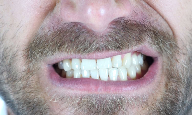 Bruxism atau kebiasaan menggertakkan gigi, Sumber: dentalhealth360.com