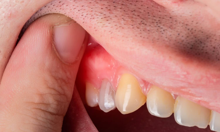 Kondisi abses gigi, Sumber; amitisdentalstudio.com.au