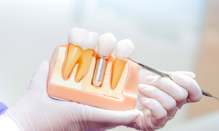 Syarat sebelum melakukan implan gigi, Sumber: audydental.com