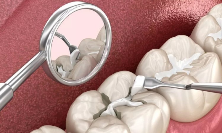 Cara merawat tambalan gigi, Sumber: audydental.com