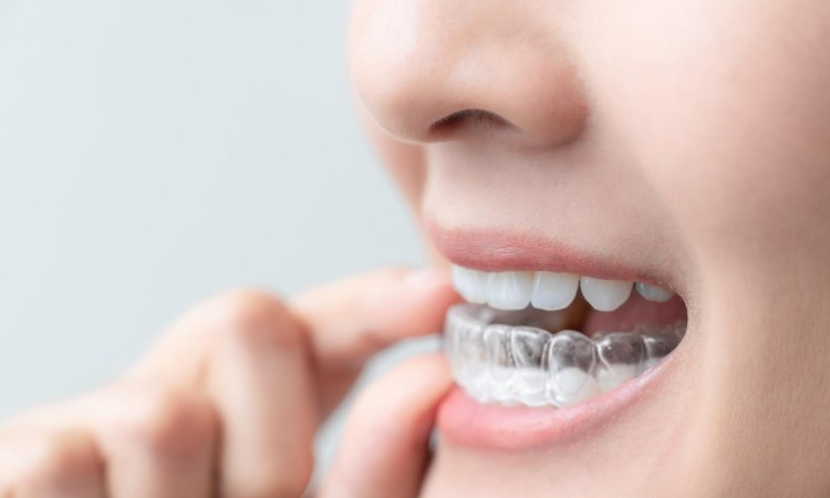 Pengertian aligner dan retainer, Sumber: ncoso.com
