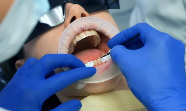 Jenis splinting gigi, Sumber: hellosehat.com