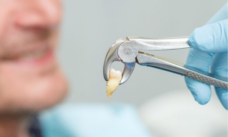 Prosedur dalam cabut gigi, Sumber: klinikdenta.com