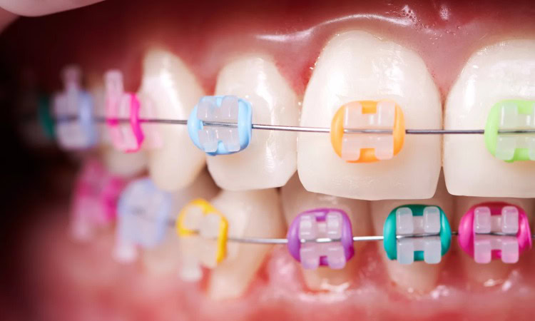 Warna karet behel, Sumber: newlookdentalcare.id