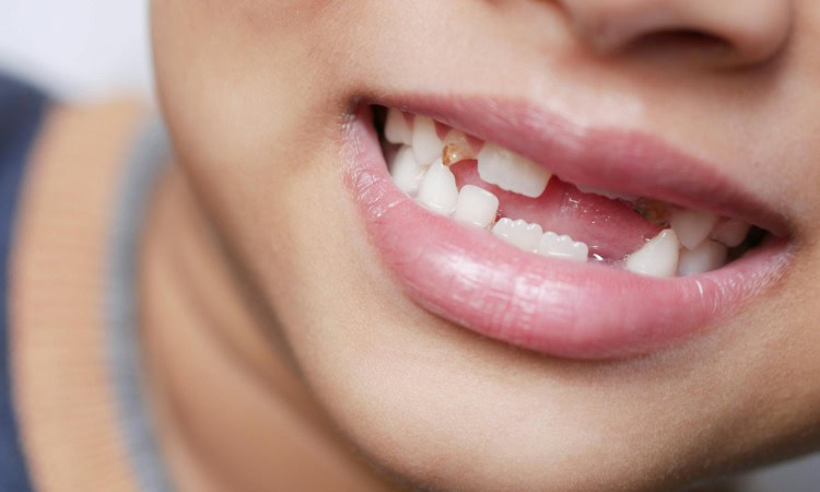 Pertumbuhan gigi anak, Sumber: pexels.com
