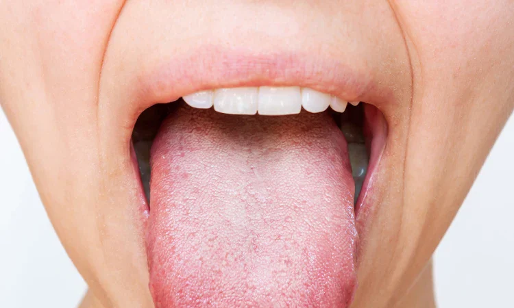 Lapisan putih pada lidah, Sumber: westgreenfamilydental.com