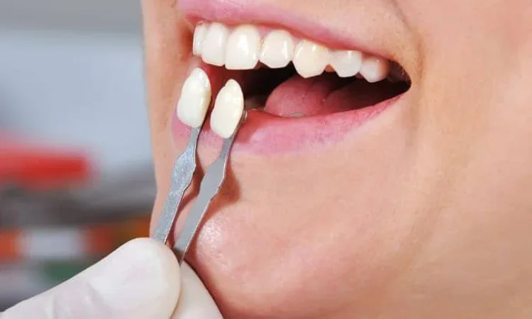 Benefit dari veneer gigi, Sumber: ladentist.com