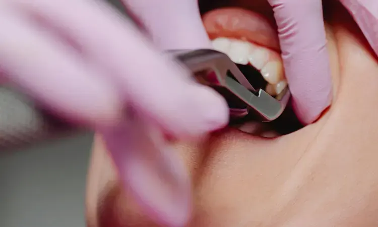 Efek cabut gigi, Sumber: pexels.com