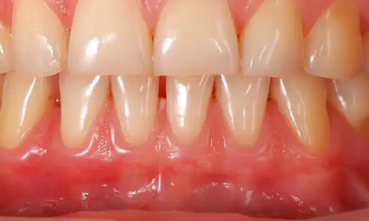 Ciri gusi yang sehat, Sumber: pittsburghsmilemakeover.com