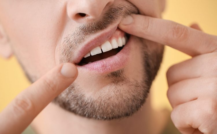 Sariawan pada gusi, Sumber: peeldentalstudio.com.au