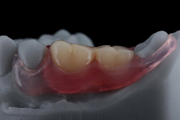 Gigi palsu valplast memiliki berbagai keunggulan, Sumber: bremadent.co.uk