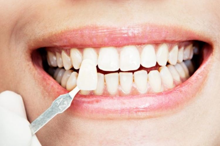 Melakukan veneer gigi, Sumber: popbela.com