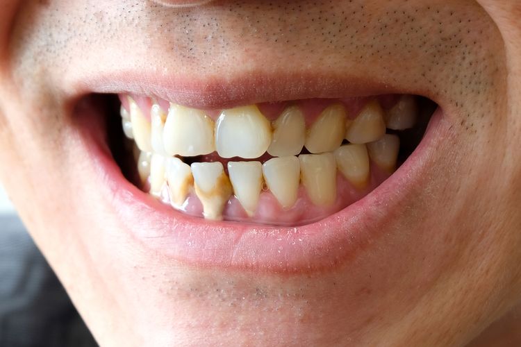 Menumpuknya sisa makanan pada gigi, Sumber: health.kompas.com