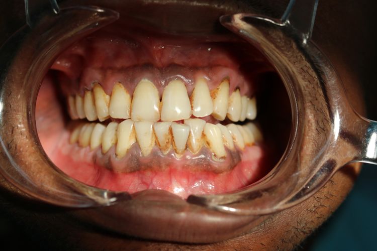 Penyebab gusi hitam bisa dikarenakan pengaruh rokok, Sumber: health.kompas.com