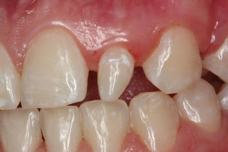 Hal-hal yang menyebabkan microdontia, Sumber: dentagama.com