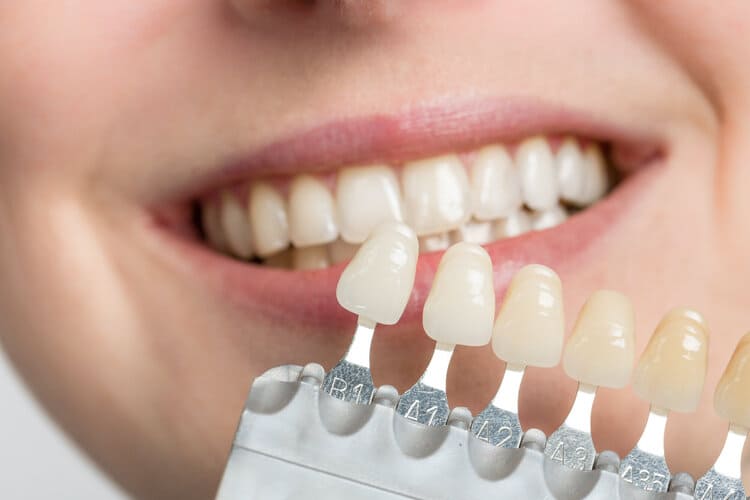 Menjalani perawatan veneer gigi, Sumber: honestteeth.com