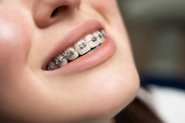 Seputar behel fashion dan behel perawatan, Sumber: bellevueorthodontist.com
