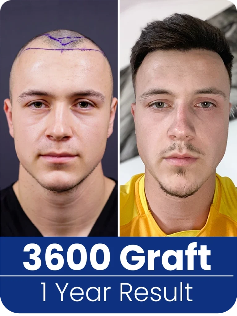 hair transplant turkey