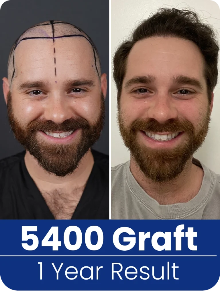 hair transplant turkey