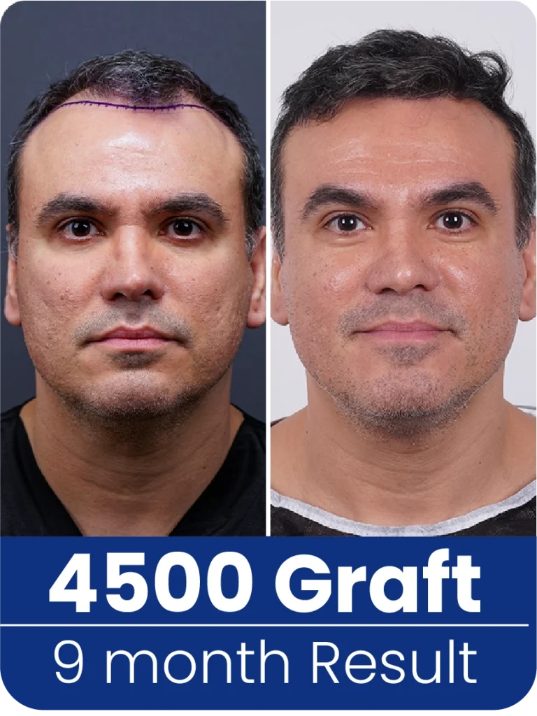 hair transplant turkey