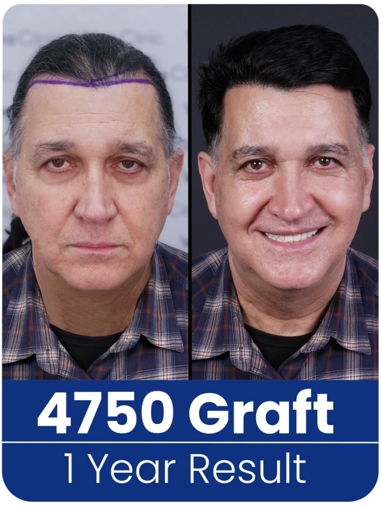 hair transplant turkey