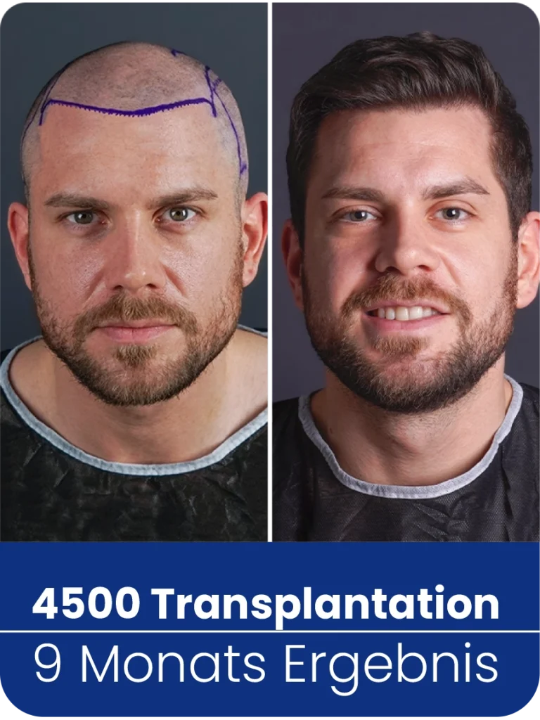 Haartransplantation Vorher Nachher