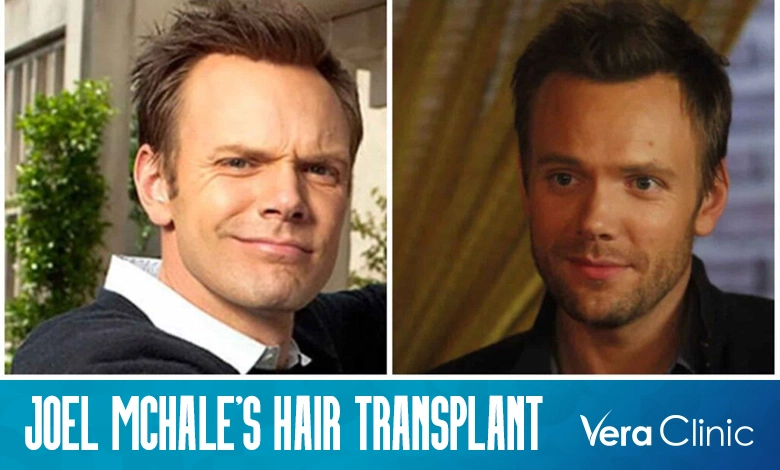 Joel McHale's Hair Transplant Journey: A Transformation Tale