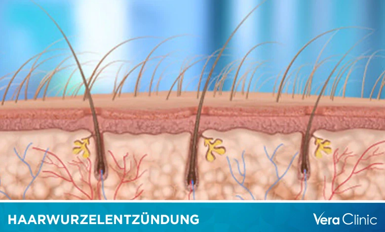 Haarwurzeln Schmerzen An Einer Stelle www.veraclinic.net