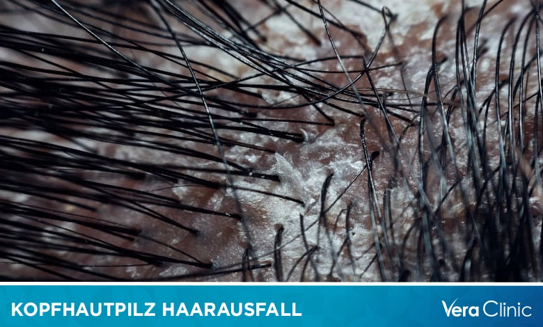 Kopfhautpilz Haarausfall
