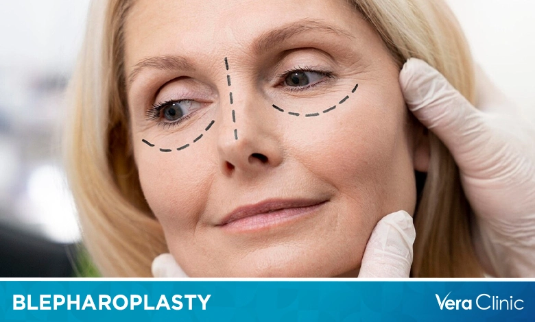 Blepharoplasty Cost