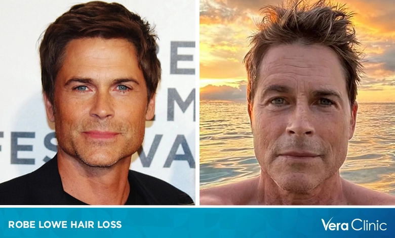 Rob Lowe Hair Loss: From Iconic 80s Hair to Hollywood Success(03)