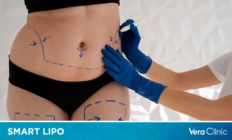 Smart Lipo Cost
