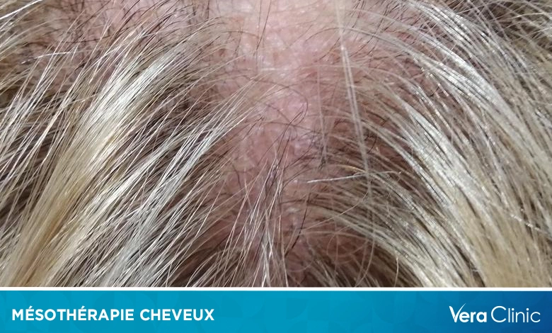 mésothérapie cheveux