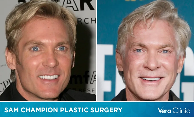 Sam Champion Plastic Surgery: Signature Look of the Famous Weatherman Sam Champion Plastic Surgery: Signature Look of the Famous Weatherman