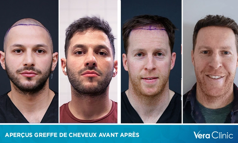 Aperçus greffe de cheveux avant après