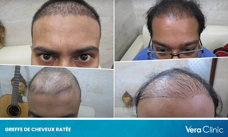 Greffe de Cheveux Ratée