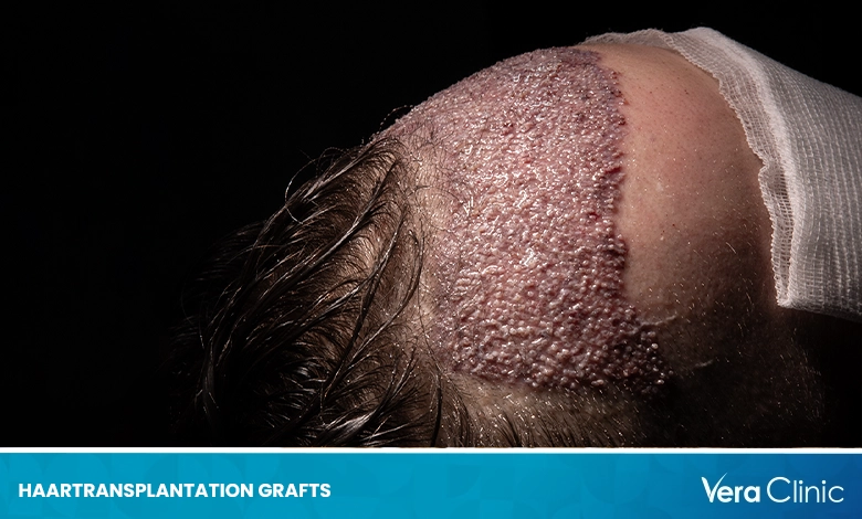 Haartransplantation Grafts