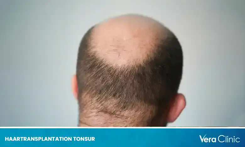 haartransplantation tonsur