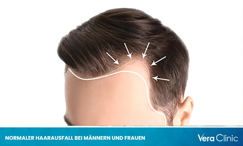 Verstehen von normalem Haarausfall bei Männern und Frauen