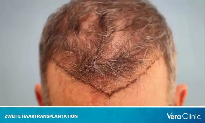 Zweite Haartransplantation