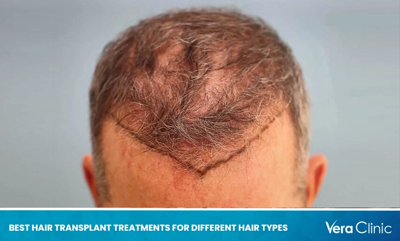 Best Hair Transplant Treatments for Different Hair Types