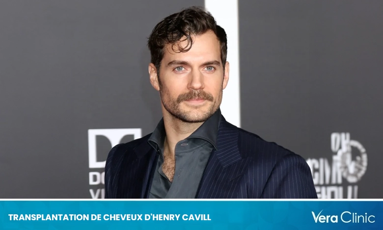 Transplantation de cheveux d'Henry Cavill