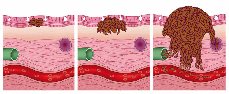 Melanoma