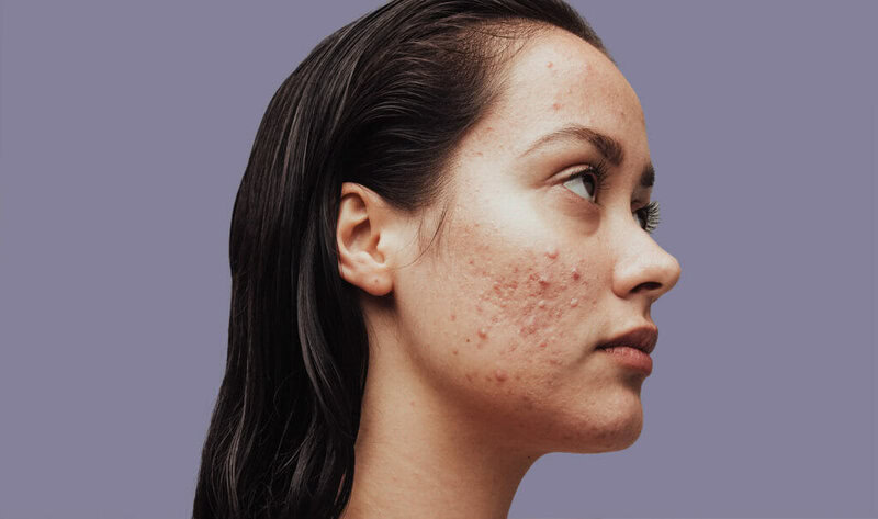 malattie-della-pelle-acne-ponticello