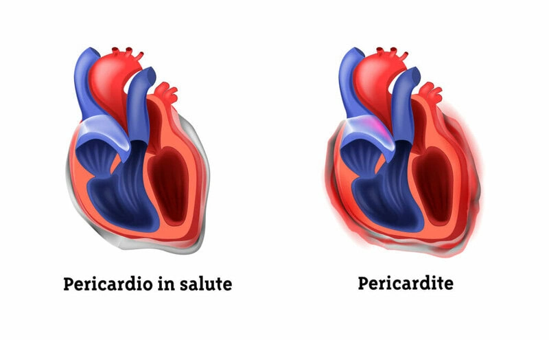 sistema-cardiocircolatorio-cuore-patologie-ponticello-pericardite