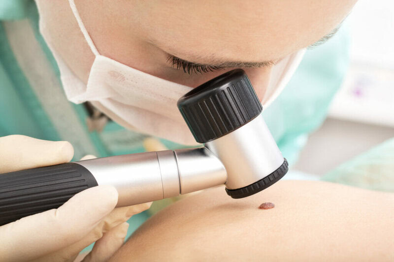Melanoma