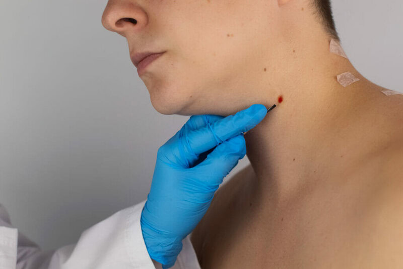 Cicatrice melanoma